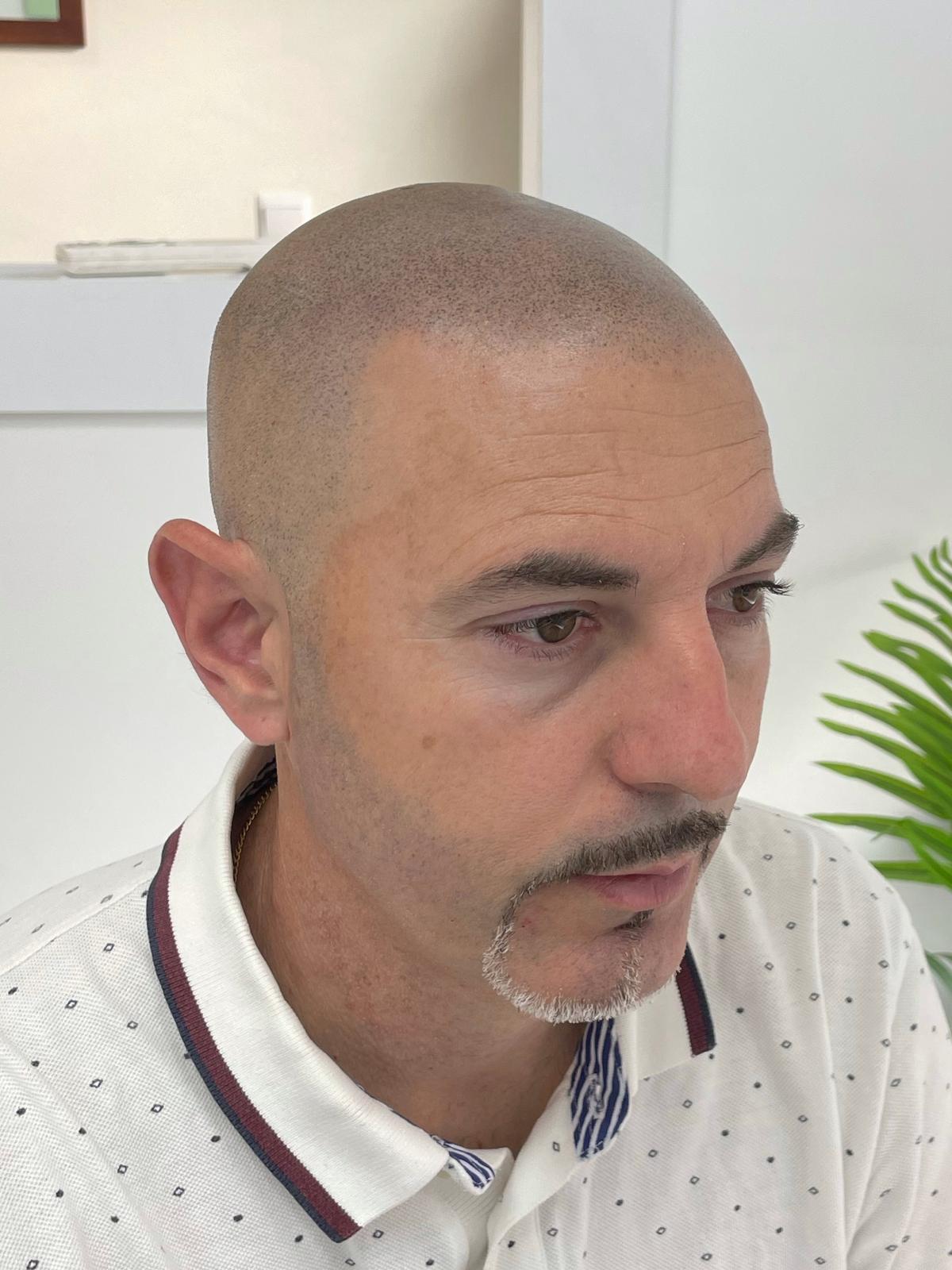 Tratamiento de densidad capilar con SMP